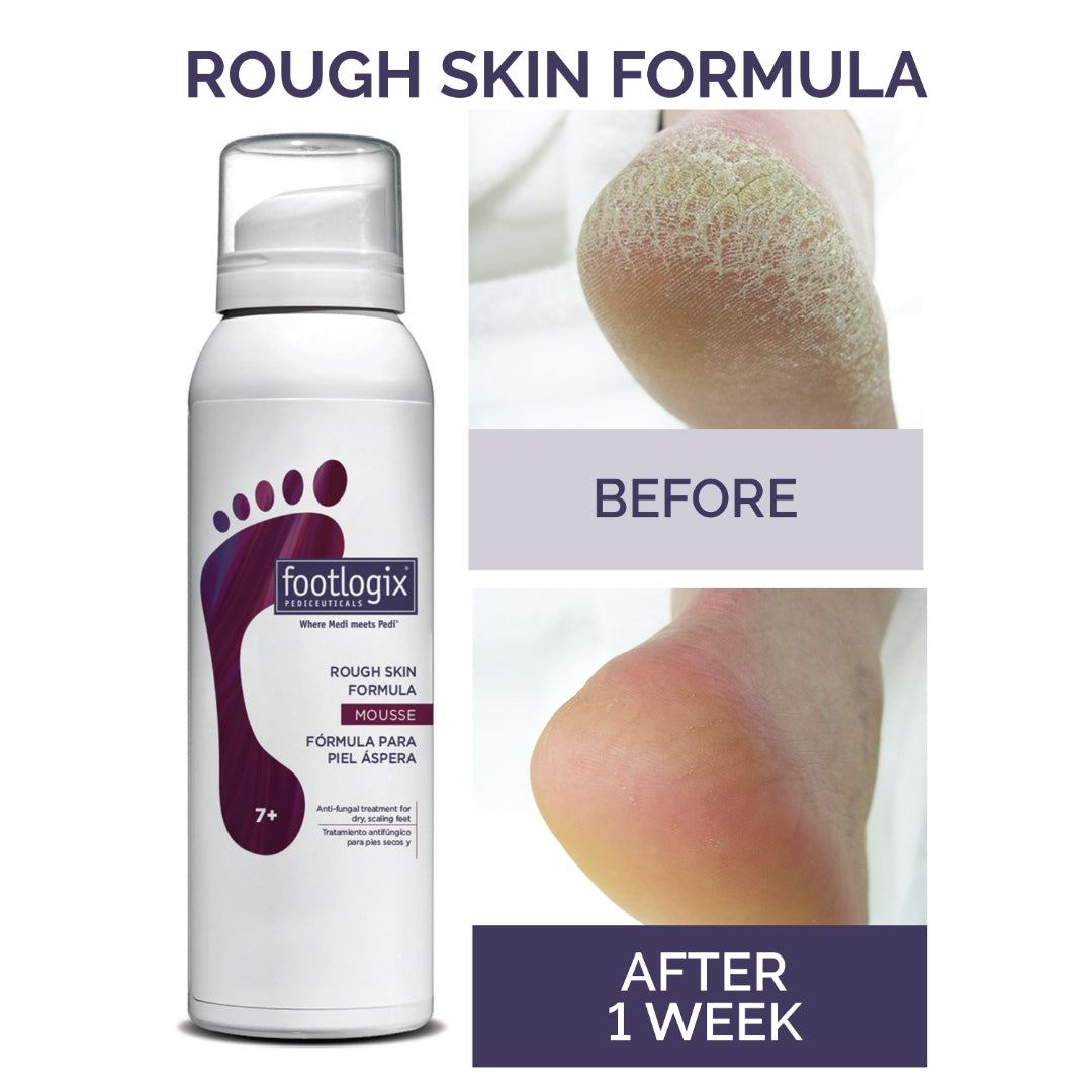 Footlogix Rough Skin Formula