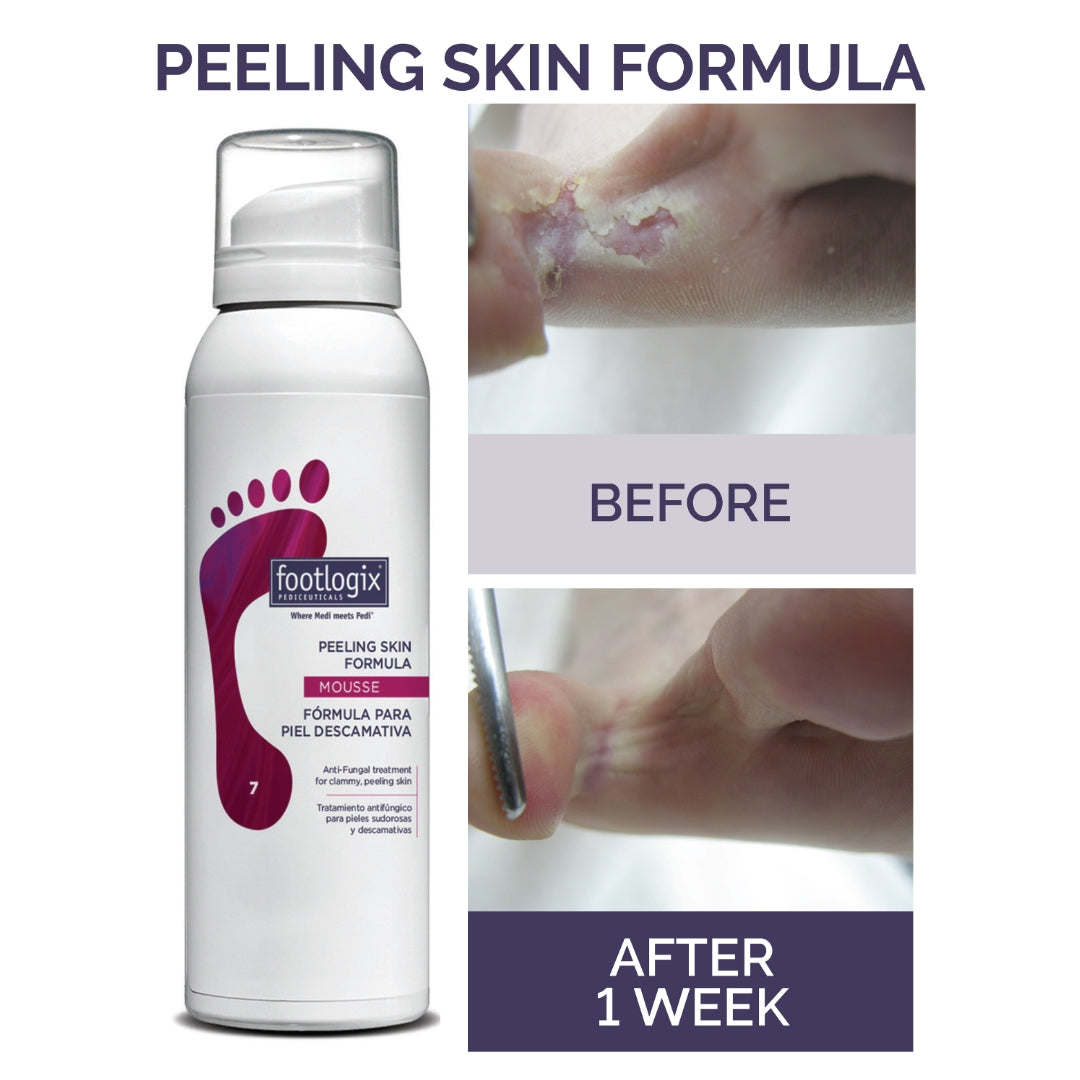Footlogix Peeling Skin Formula