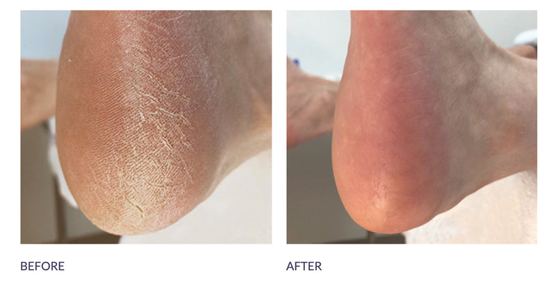 Footlogix Callus Softener &amp; File Combo